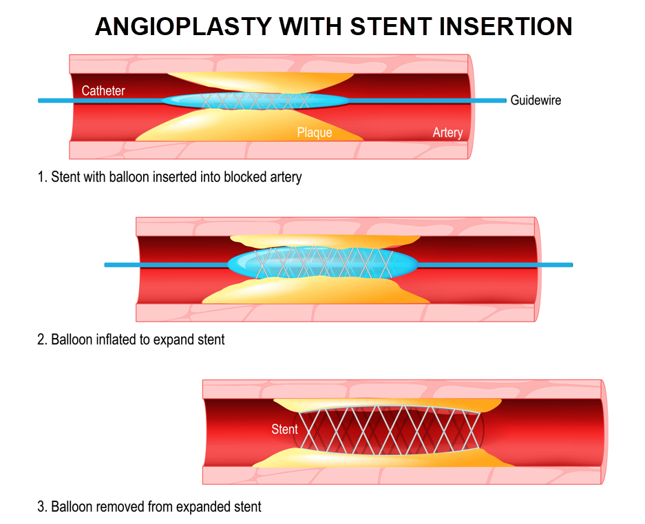 coronary angioplasty stent icd 10