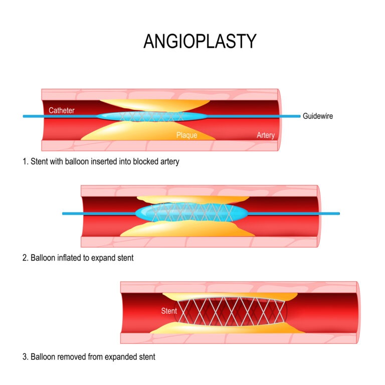 Illustration of angioplasty procedure showing steps: 1) stent with balloon inserted in blocked artery, 2) balloon inflated, 3) balloon removed, leaving stent in place.